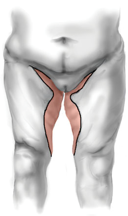 femoroplastika 2