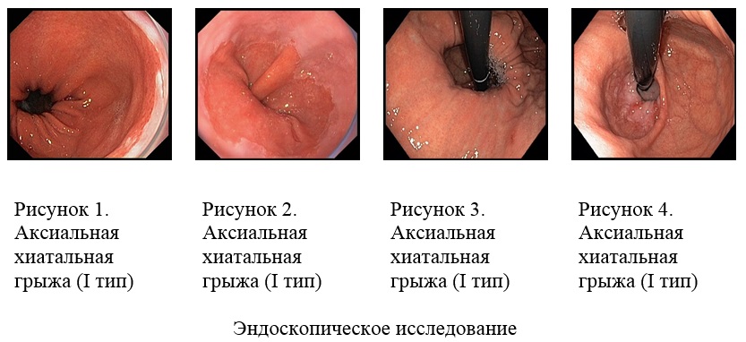 Endoskop1