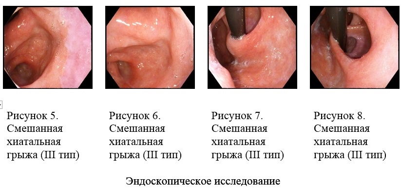 Endoskop2