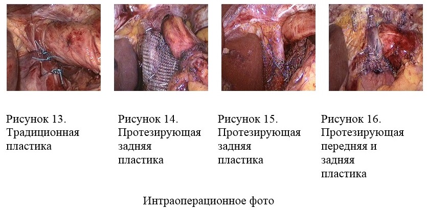 intraoper3 1