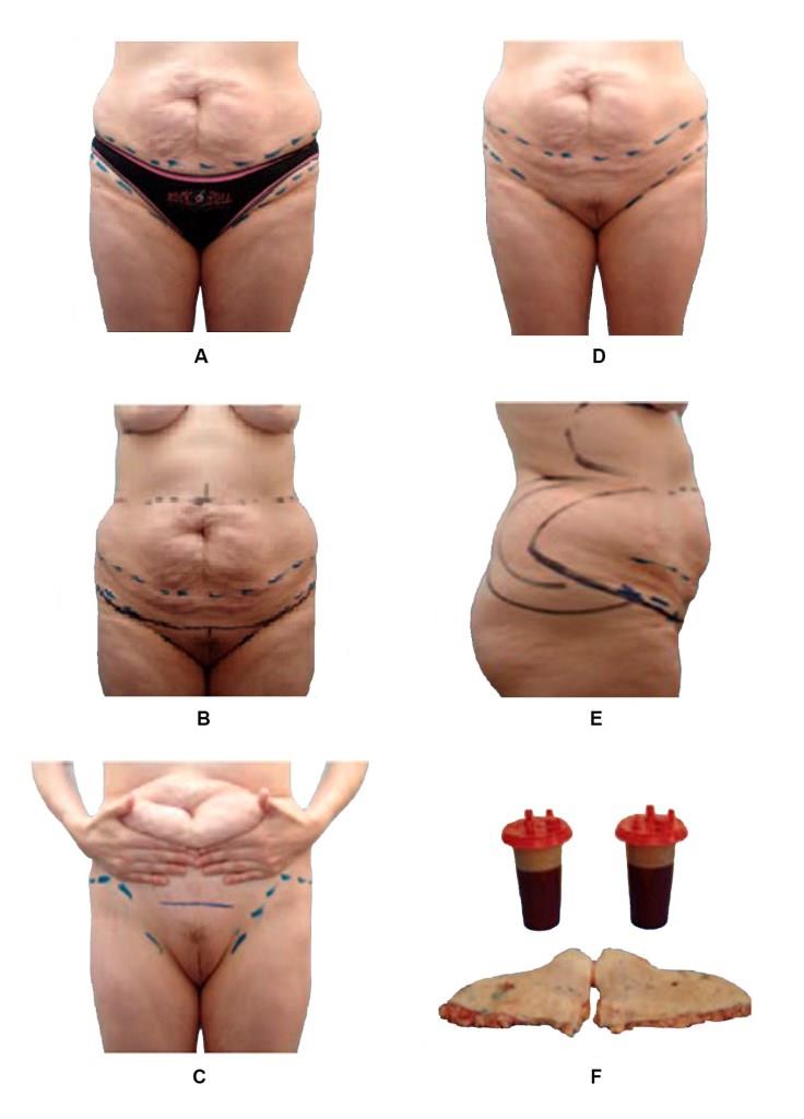 Разметка спереди перед расширенной абдоминопластикой (Hunstad J. Atlas of Abdominoplasty, 2009, с измен.)