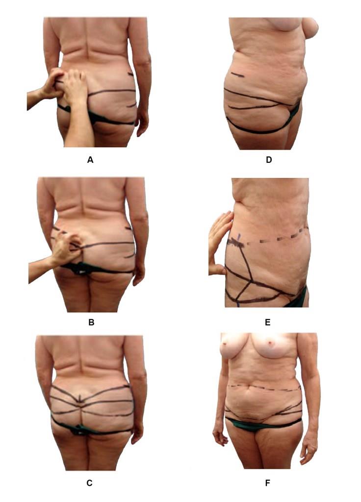 Разметка сзади перед расширенной абдоминопластикой (Hunstad J. Atlas of Abdominoplasty, 2009, с измен.)