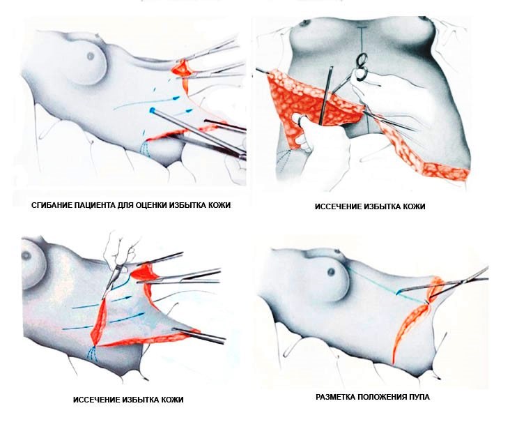 standart abdominoplastika