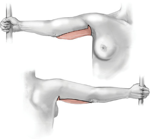 brahioplastika 2