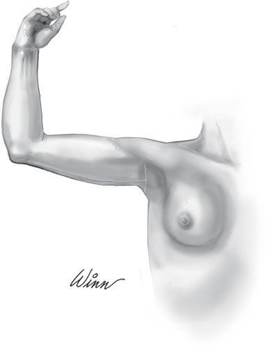 brahioplastika 3