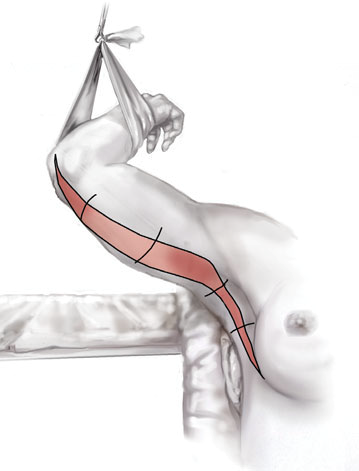 brahioplastika 4
